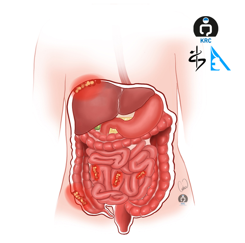 peritoneal-karsinomotoz
